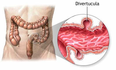 Diverticular disease diagram